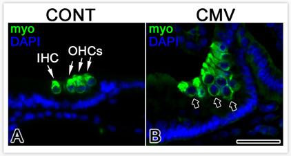 CMV and Deafness